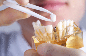 Dental Implants