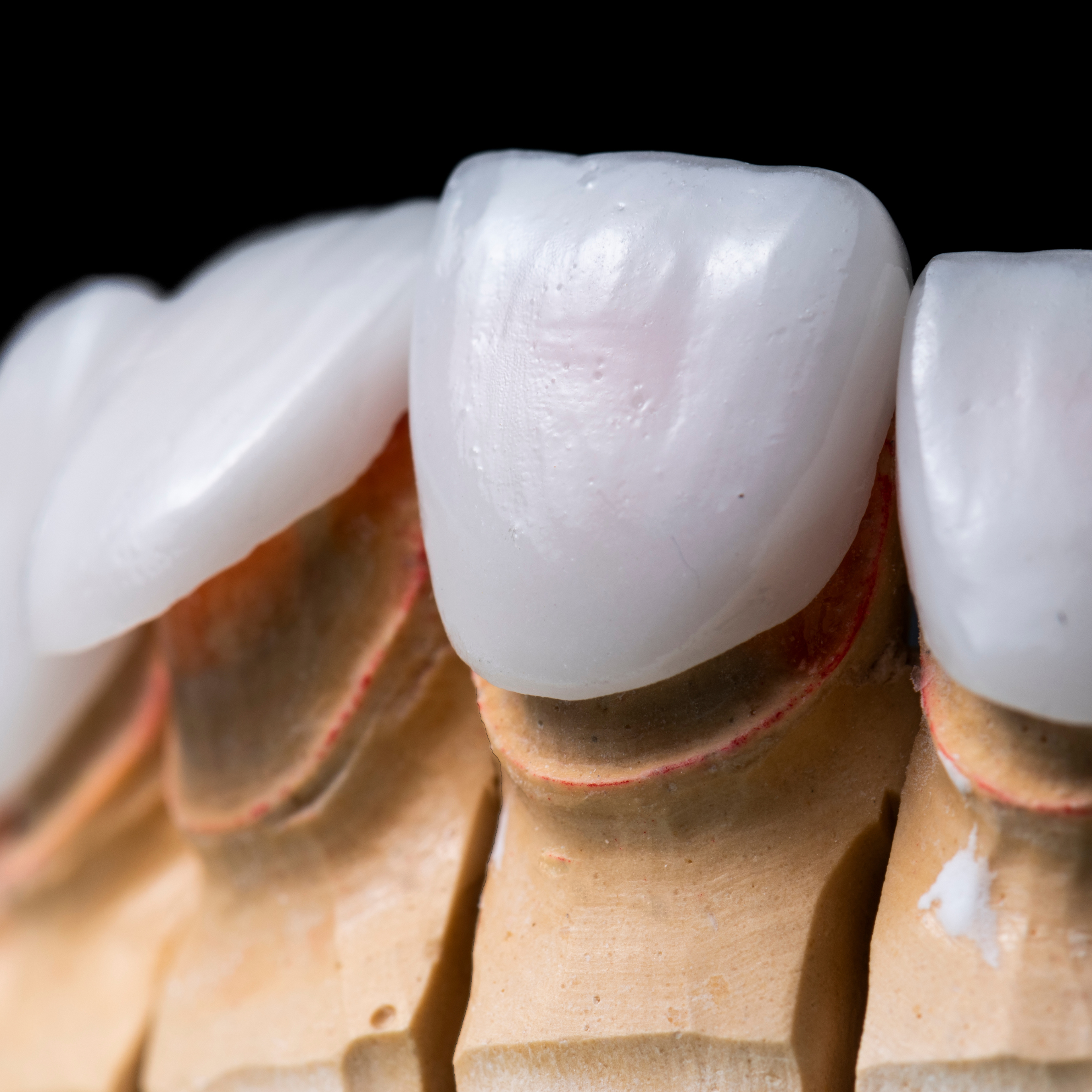 Dental veneers