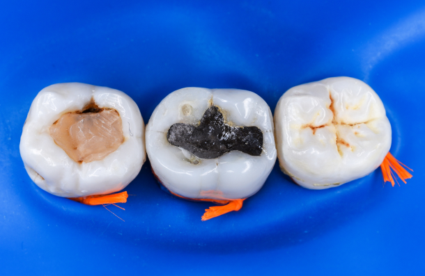 Amalgam fillings