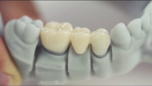 Dental Bridge