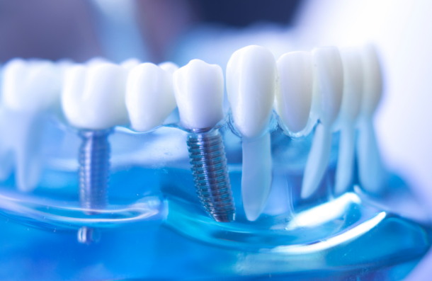 Multiple dental implants on a model