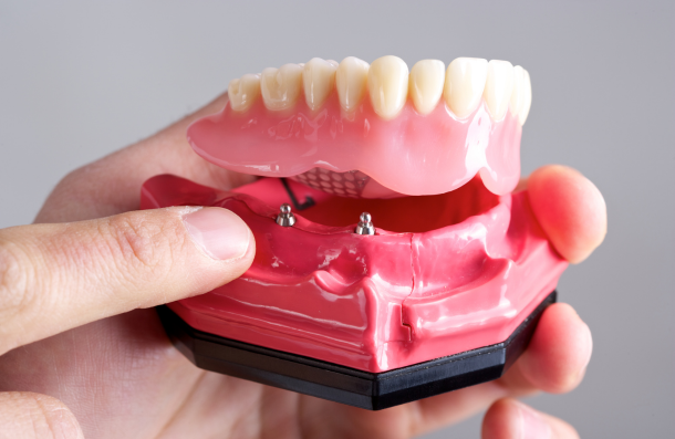 implant retained dentures on a model