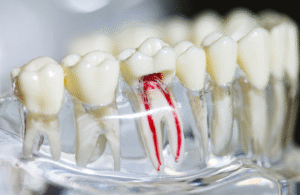 Root Canal Treatment