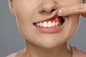 gingivitis