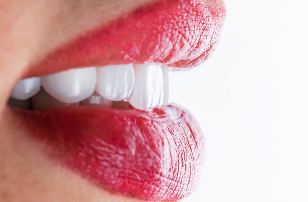 composite bonding white teeth red lipstick close up
