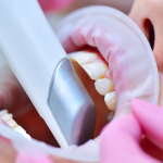 Intra Oral Scanning
