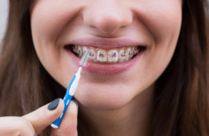 How to Care for Braces and Retainers