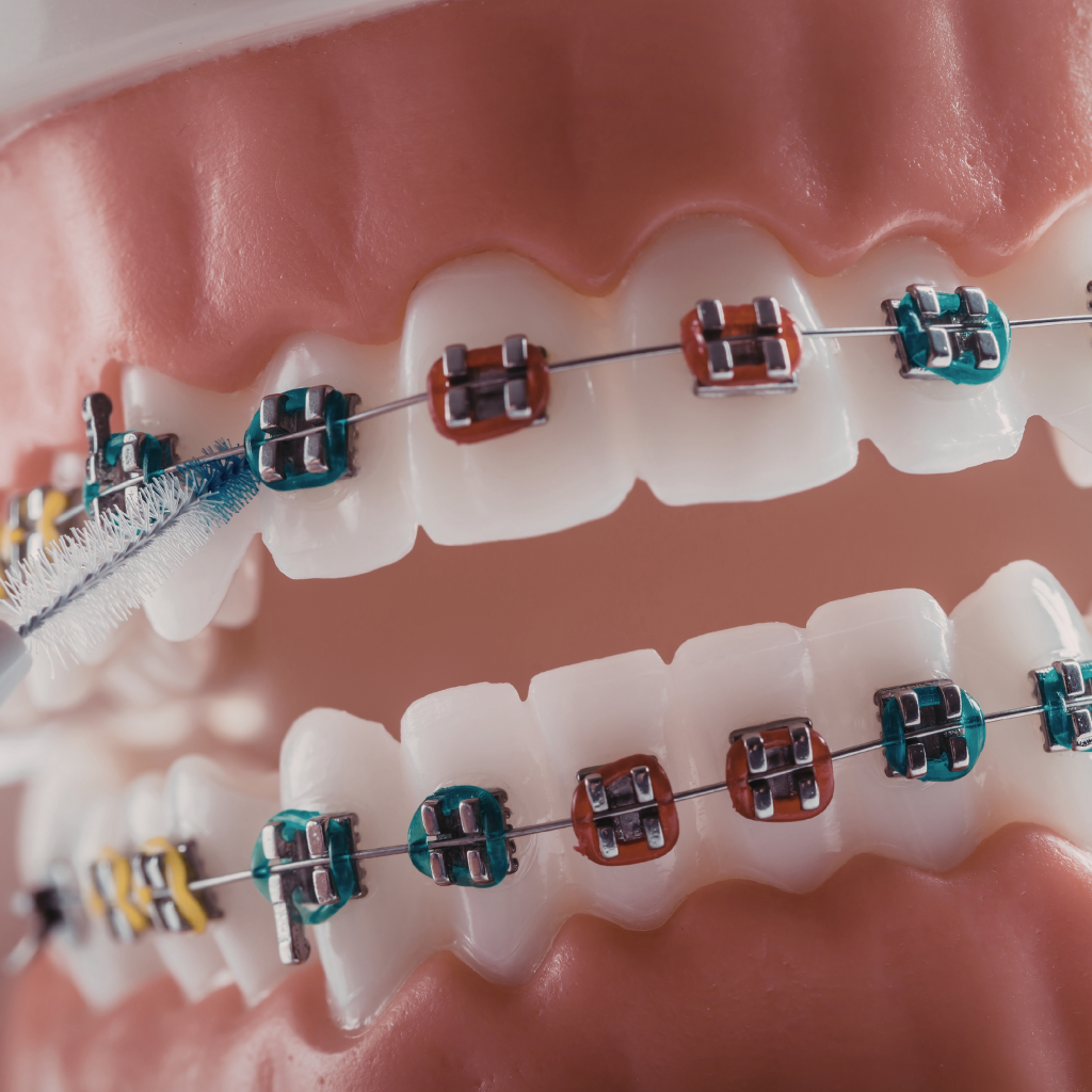 id cleaning braces