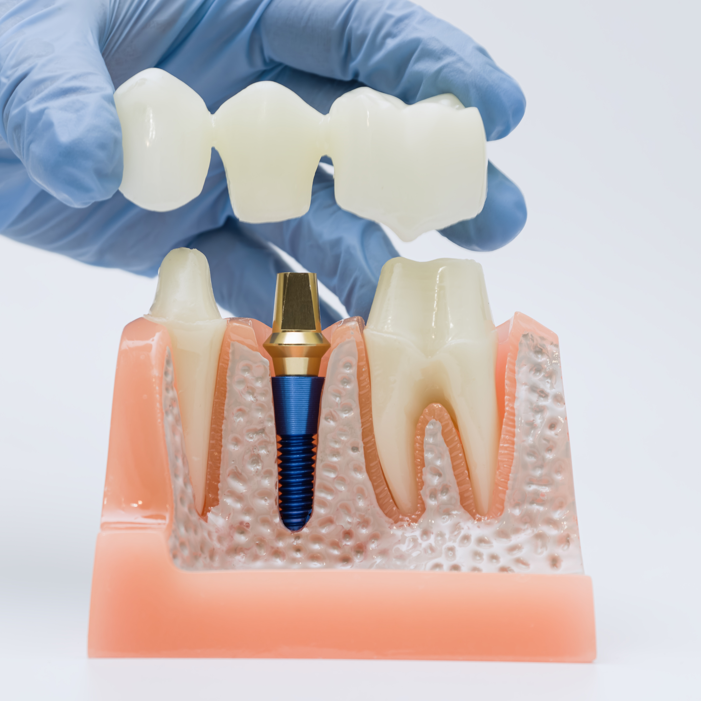 dental implant graphic