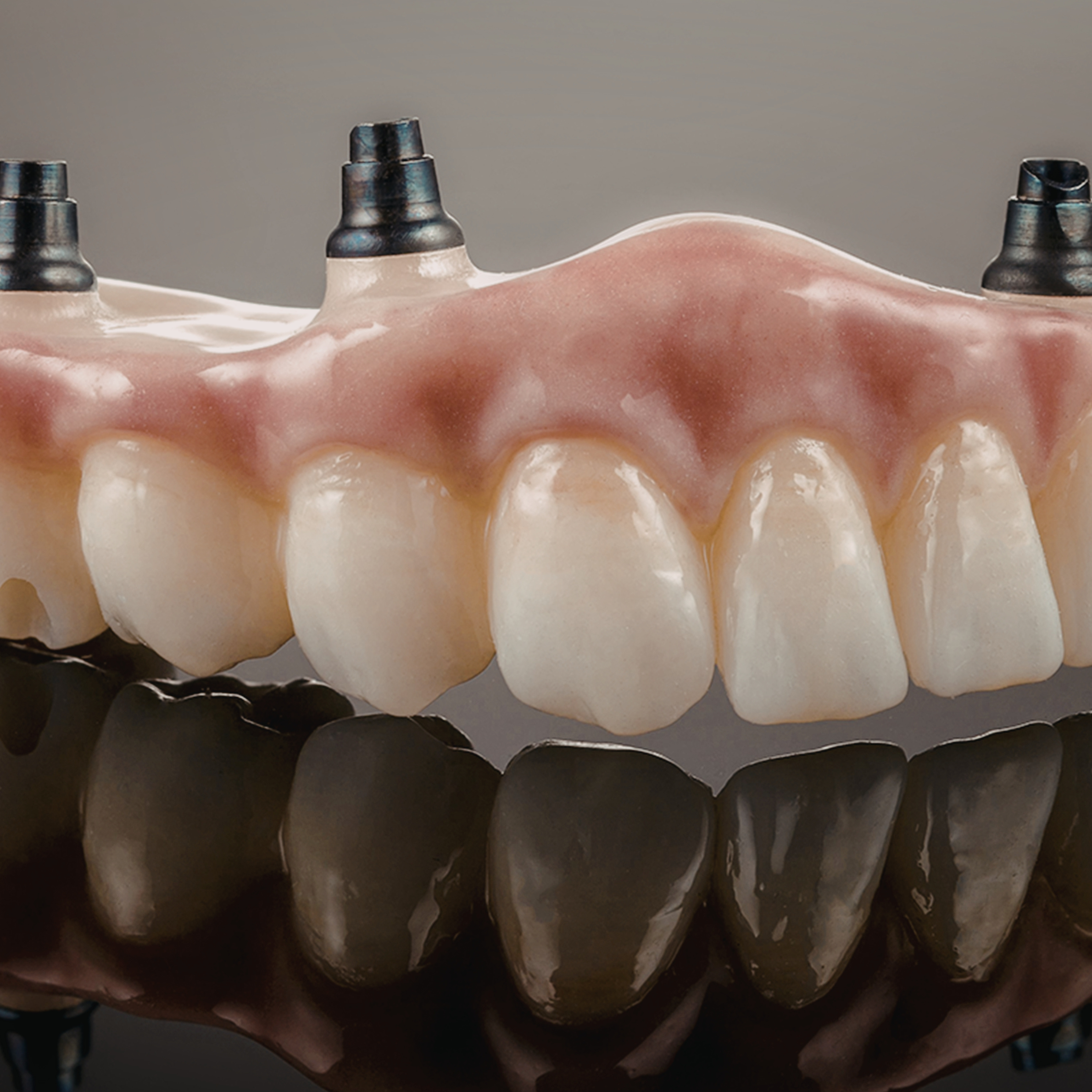 dental implant retained denture