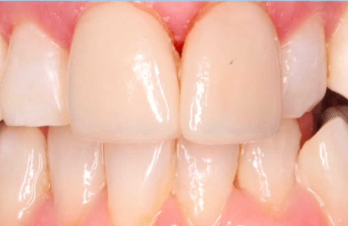 After - Abbey Mead Dental & Implant Clinic