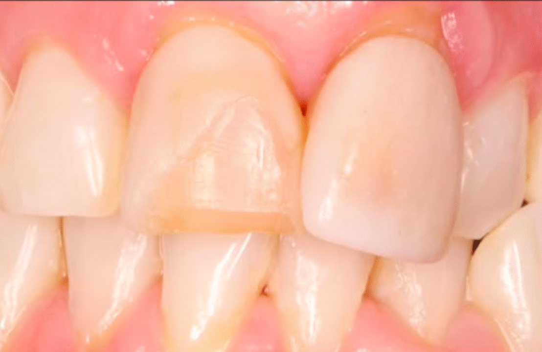 Before - Abbey Mead Dental & Implant Clinic