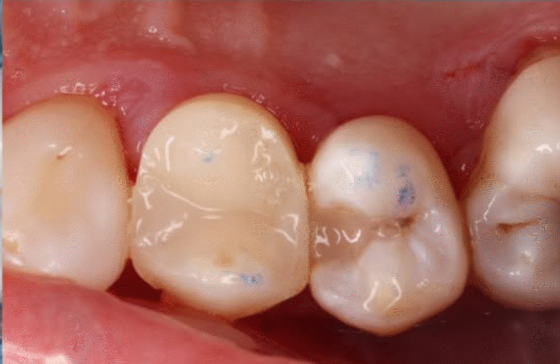 After - Abbey Mead Dental & Implant Clinic