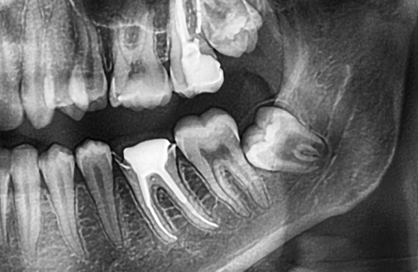 Wisdom teeth xray