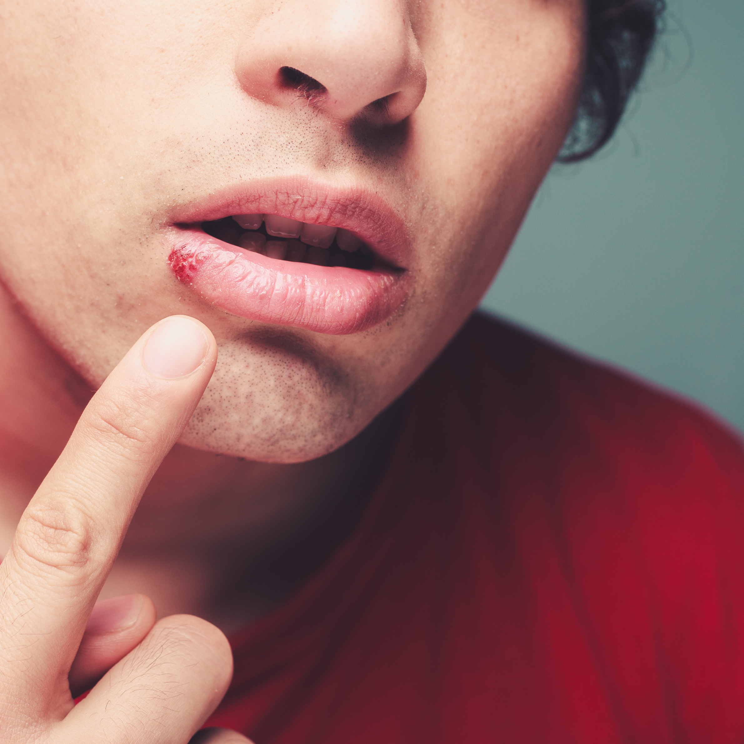 Man pointing to cold sore