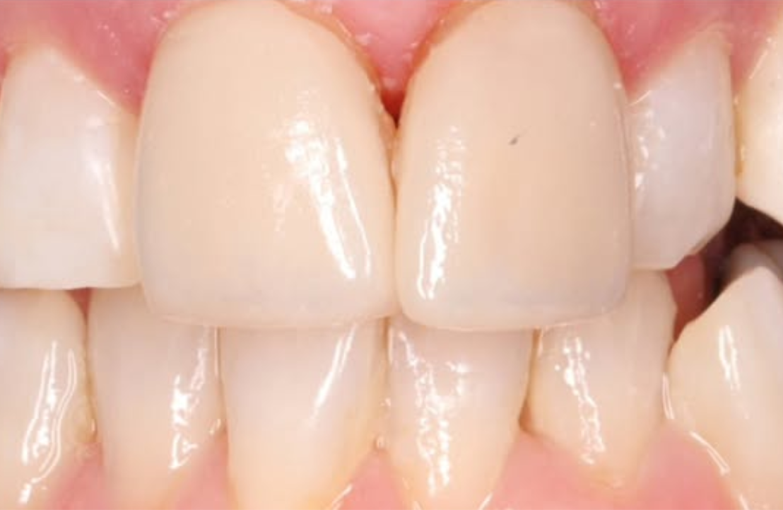 Anterior veneers after photo