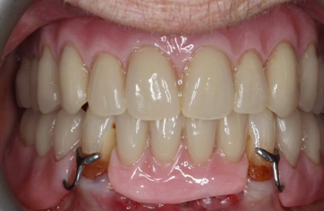 Upper denture after photo