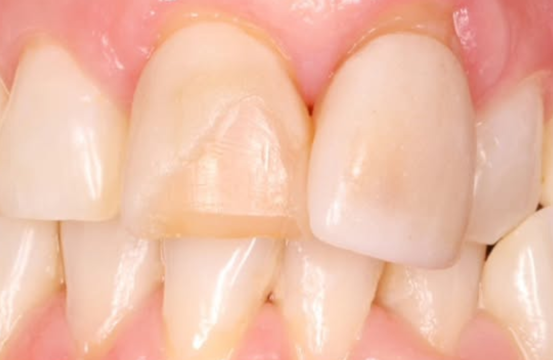 Anterior veneers before photo