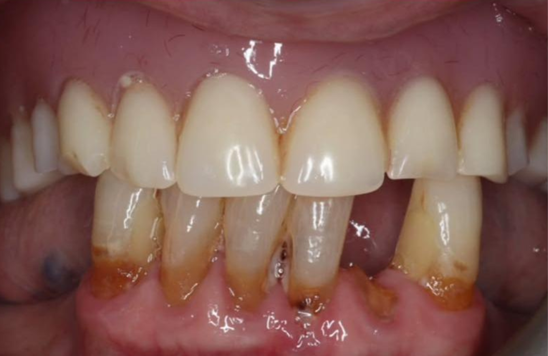 Upper denture before photo