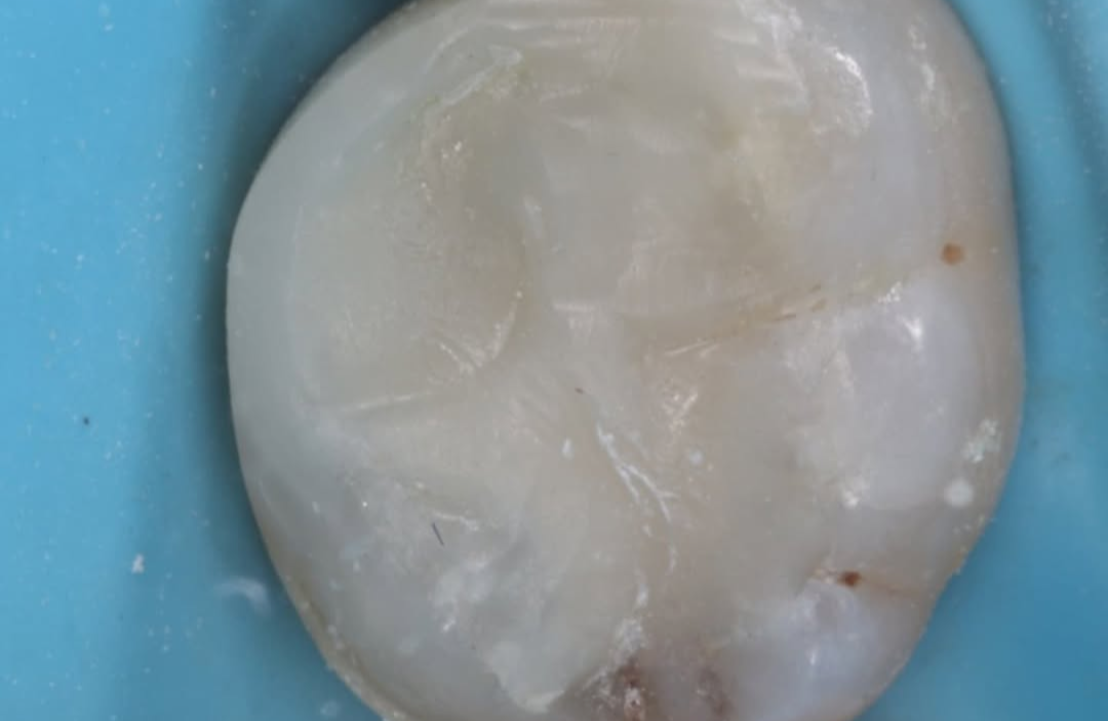 Composite restoration after photo