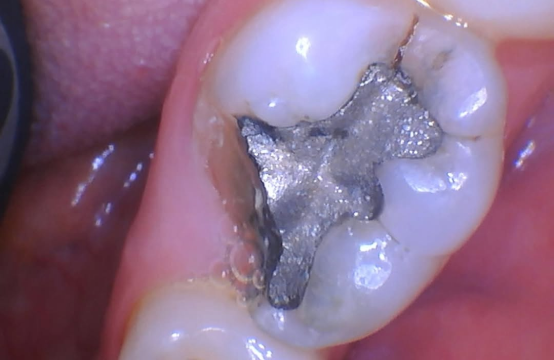 Composite restoration before photo