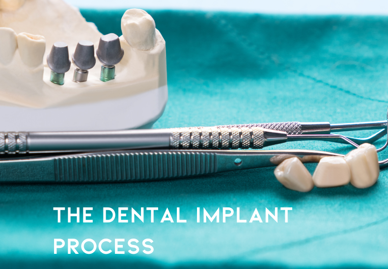 implant process featured image