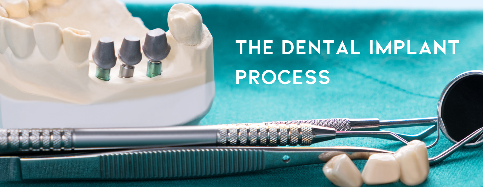 Implant process blog banner