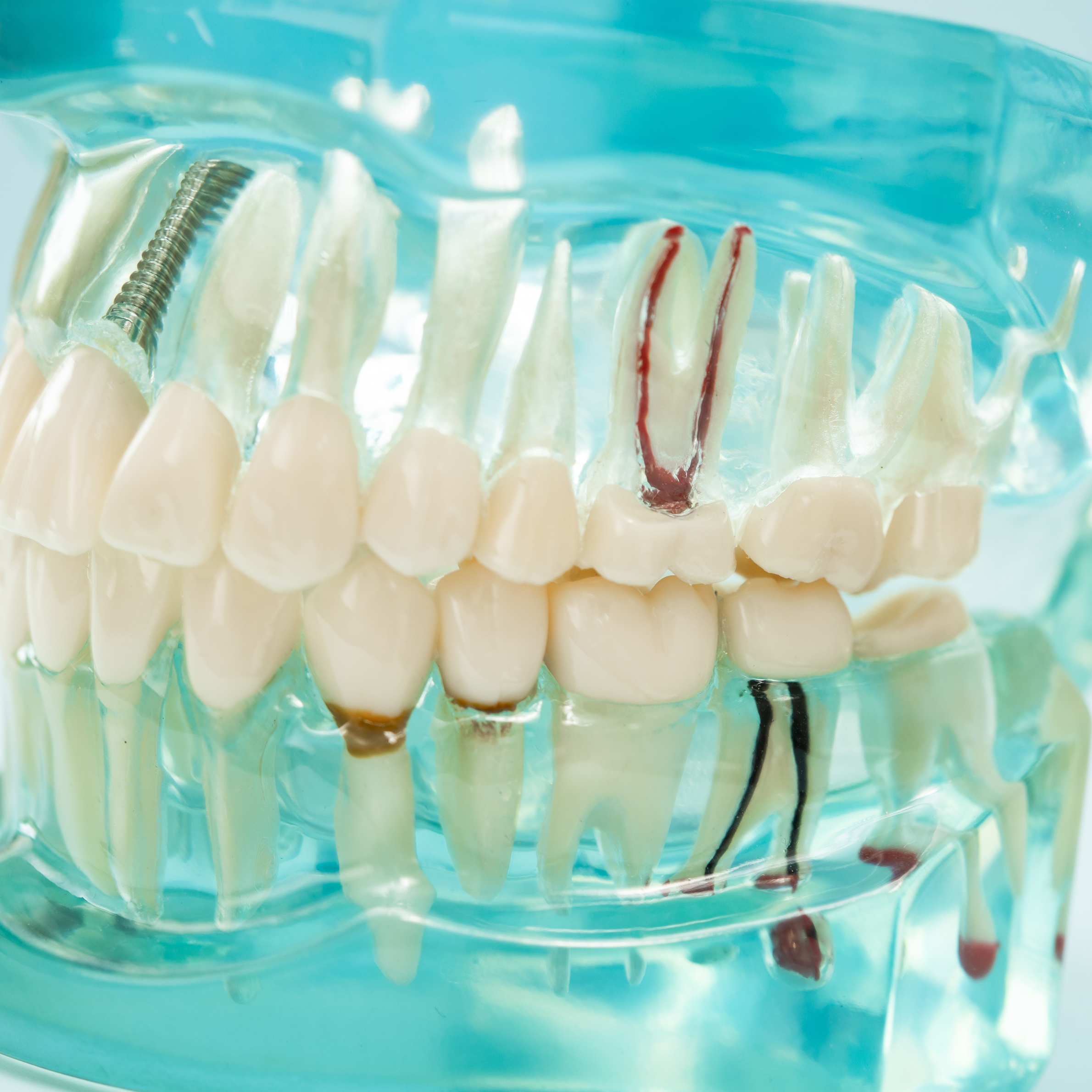 root canal treatment shown on a model