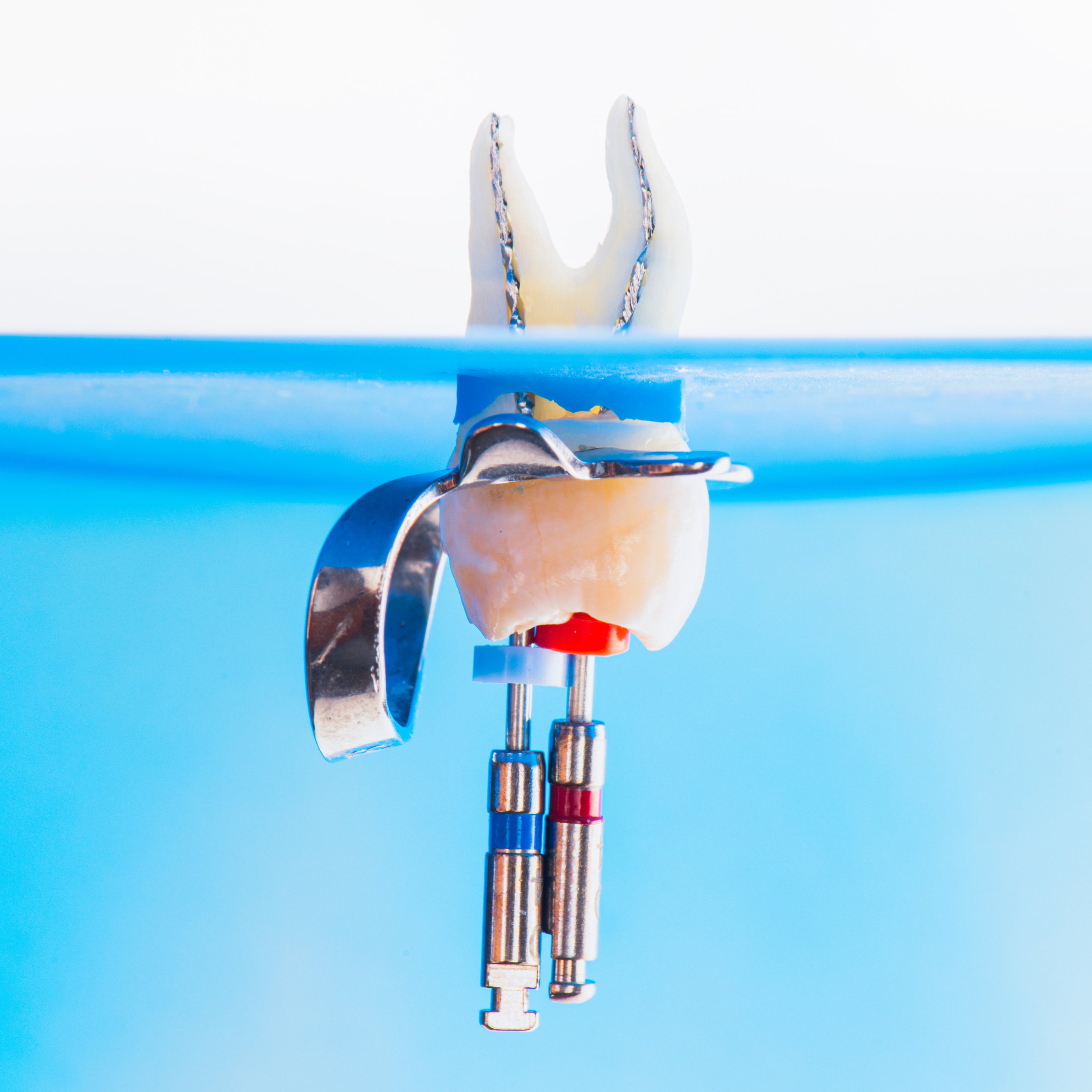 Tooth with root canal instruments inside