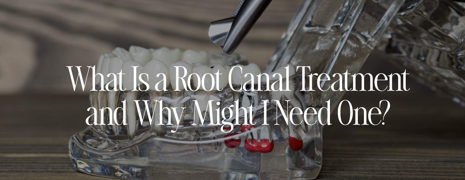 What is a root canal Abbey Mead Tavistock